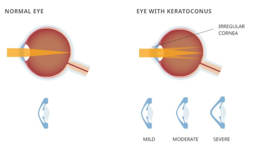 What is Keratoconus? Hashmanis Group of Hospital